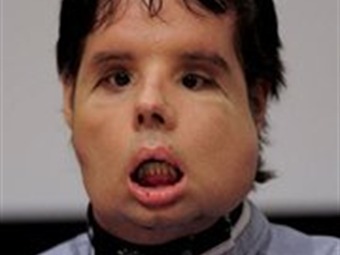 Noticia Radio Panamá | Dan el alta a la primera persona con trasplante total de rostro en el mundo