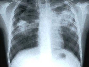 Noticia Radio Panamá | OMS pide el retiro de los serodiagnósticos para la tuberculosis
