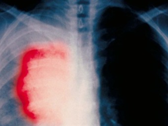 Noticia Radio Panamá | La terapia del cáncer de pulmón busca suprimir la quimioterapia