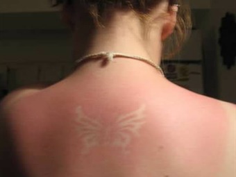 Noticia Radio Panamá | La peligrosa moda de los tatuajes solares que alarma a los dermatólogos