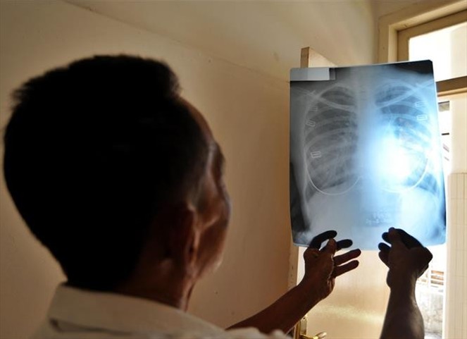 Noticia Radio Panamá | 150 casos de tuberculosis han sido detectados durante primer trimestre del 2019