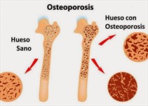 Noticia Radio Panamá | Osteoporosis: prevenir y tratar fracturas óseas con la edad