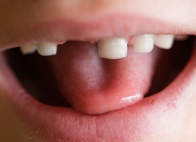 Noticia Radio Panamá | Extraen 526 dientes a un niño de siete años