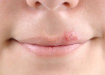 Noticia Radio Panamá | Virus del herpes labial para combatir el cáncer de piel
