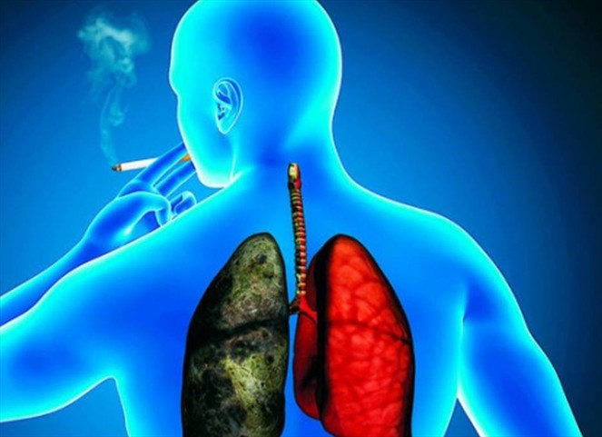 Noticia Radio Panamá | Alrededor de 1.800.000 personas son diagnosticadas con cáncer de pulmón anualmente