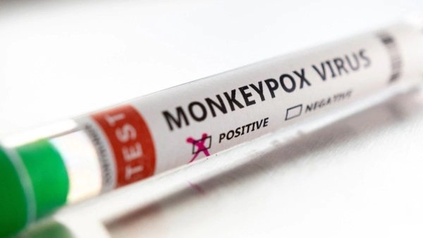 Featured image for “MINSA confirma la detección de 5 nuevos casos de viruela del mono; casos aumentan a 26”