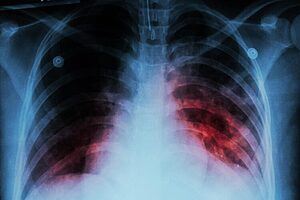 “Panamá busca reducir en un 75% la mortalidad por tuberculosis”