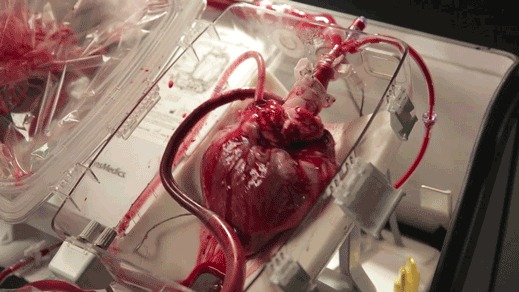 Featured image for “Trasplantan un corazón que dejó de latir durante 20 minutos”